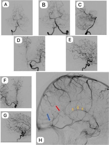 Delayed Perimesencephalic Subarachnoid Hemorrhage Probably Related to Remote Head Trauma: A Case Report