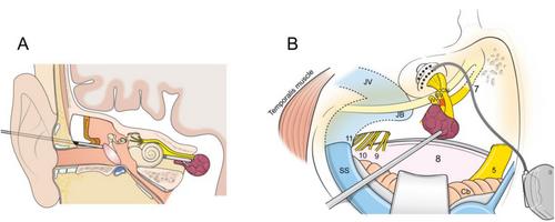 Simultaneous Translabyrinthine Vestibular Schwannoma Removal and Cochlear Implantation: Assessment of Wireless Connection Speech Test