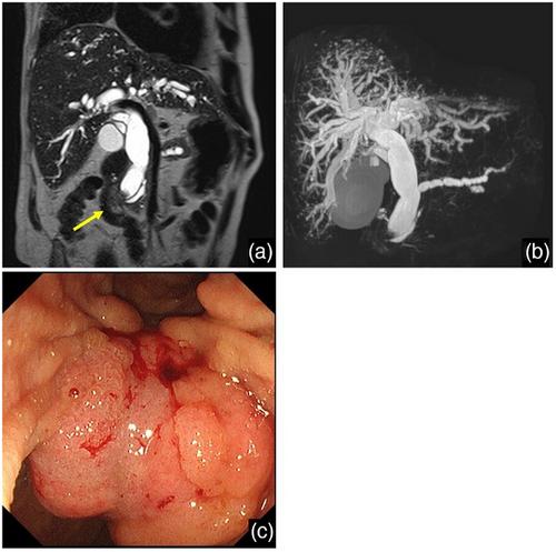 Rupture of Life-Threatening Hepatic Artery Pseudoaneurysm After Endoscopic Ultrasonography-guided Hepaticogastrostomy: Successful Management With Emergency Transcatheter Arterial Embolization