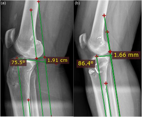Combined revision ACL reconstruction with slope-correction osteotomy and lateral extra-articular tenodesis improves stability in patients with high posterior tibial slope and pivot shift