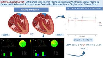 Left bundle branch area pacing versus conventional pacing in patients with advanced atrioventricular conduction abnormalities: a prospective cohort study