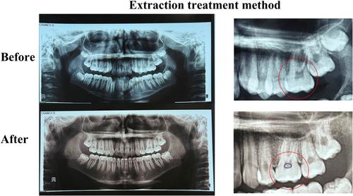 Pulp Stone Formation Following Fixed Orthodontic Treatment: A Panoramic Radiographic Comparison of Extraction and Non-Extraction Approaches