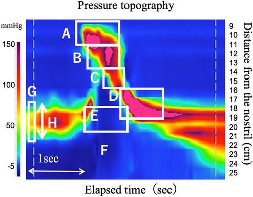 High-Resolution Pharyngeal Manometry Assessment of Swallowing in Asymptomatic Myotonic Dystrophy