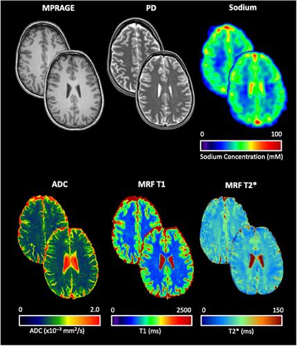 Multimodal Quantitative MRI Atlas of the Human Brain in Healthy Young Adults