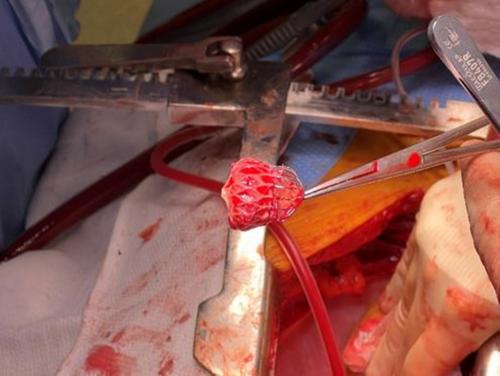 A Case of Idiopathic Chest Pain Following Watchman Device Placement