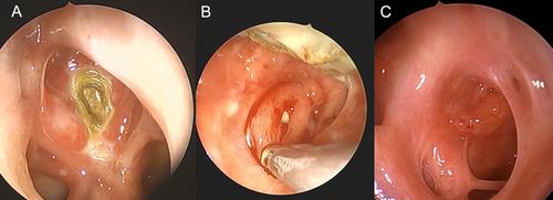 Collagen Matrix Combined With Hydroxyapatite and Nasoseptal Flap for Skull Base Reconstruction