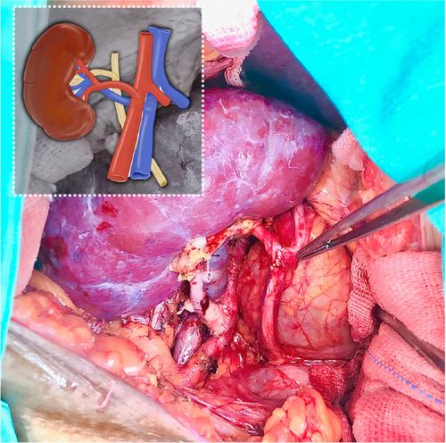 Reduced Surgical Complications After Deceased-Donor Kidney Transplantation Using Inverted Allograft and Ultrashort Ureteroureterostomy: A Single-Center Experience