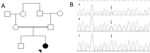 Glycine N-Acyltransferase Deficiency due to a Homozygous Nonsense Variant in the GLYAT: A Novel Inborn Error of Metabolism