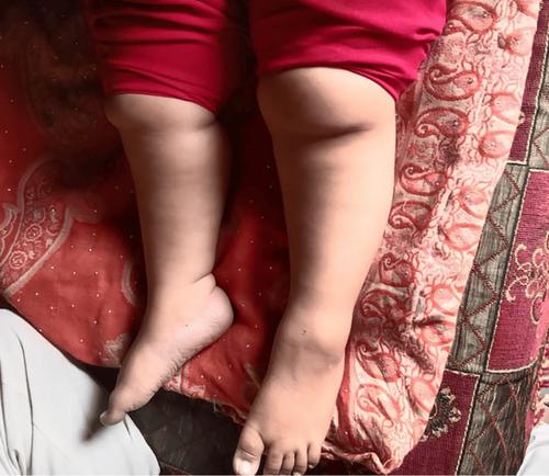 Rare Case of Laurence–Moon–Bardet–Biedl Syndrome With Pulmonary Hypertension: A Case Report