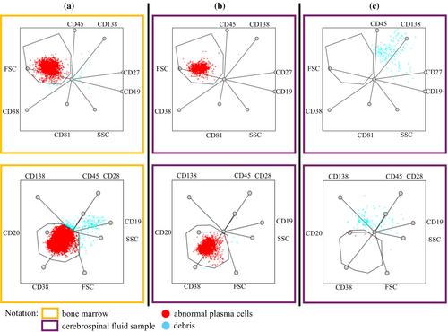 Enhancing detection of central nervous system involvement in multiple myeloma: A novel multidimensional dot-plot based analysis for flow cytometry