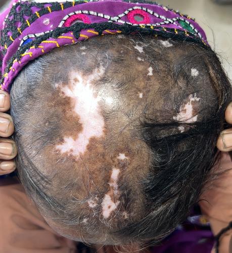A Rare Case of Lichen Planus/Discoid Lupus Erythematosus Overlap Syndrome and Its Successful Treatment