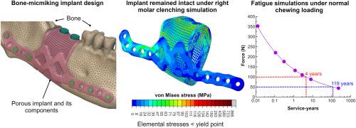 Prototype design of porous Ti6Al4V intraosseous implant for use in mandibular reconstruction