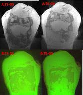 Biomimetic management of orthodontic white spot lesions