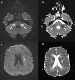 Bilateral middle cerebellar peduncle infarcts in a patient with systemic lupus erythematosus