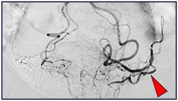 Anomalous Origins of the Prostatic Artery from the Inferior Mesenteric Artery Identified during Prostatic Artery Embolization