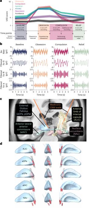 Intracranial electrophysiological biomarkers of compulsivity in obsessive–compulsive disorder