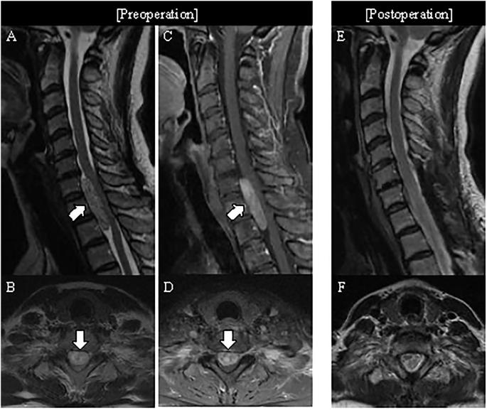 Surgical and clinical outcomes of ventral versus dorsal/lateral intradural extramedullary schwannomas: a retrospective comparative study
