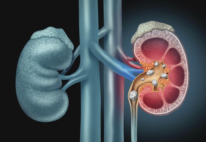 Boosting precision and confidence in percutaneous nephrolithotomy