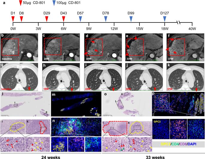 Differentiation therapy with hepatocyte nuclear factor 4α for patients with hepatocellular carcinoma