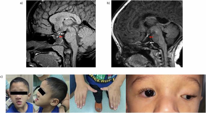 Expanding the clinical and molecular spectrum of TBC1D32-related ciliopathy: case reports and literature Review