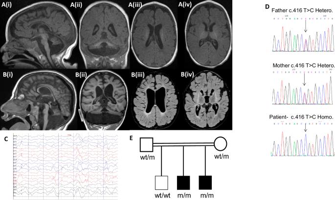 Biallelic MED29 variants cause pontocerebellar hypoplasia with cataracts