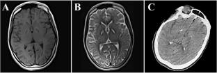 Endocrinopathy, dystonia, and tremor in a patient with homozygous MRPL49 mutation