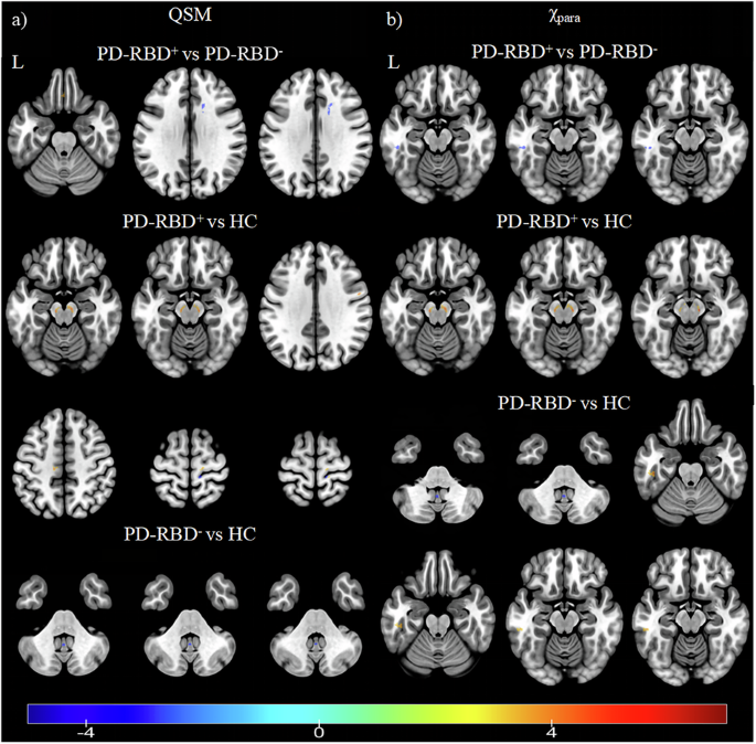 Paramagnetic susceptibility mapping better quantifies brain iron content in Parkinson’s disease with RBD