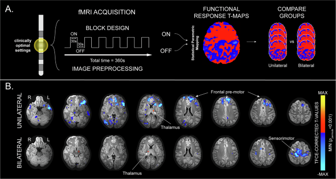Functional network differences between unilateral and bilateral deep brain stimulation of the subthalamic nucleus