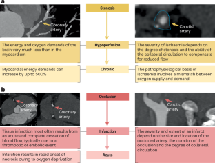 Myocardial infarction, stroke and arterial stenosis: time to reassess a major misunderstanding