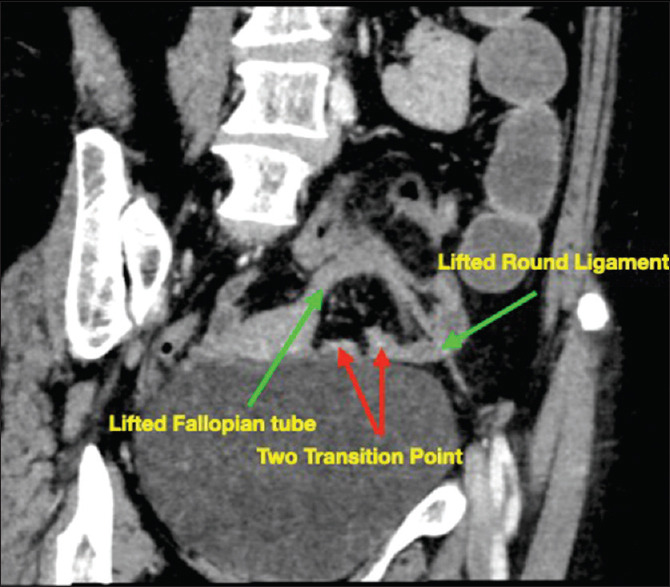 An unusual case of small-bowel obstruction: Broad ligament hernia.