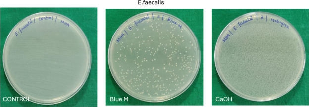 Antimicrobial efficacy of blueM gel and calcium hydroxide against F. nucleatum and E. faecalis biofilm: an ex-vivo study.
