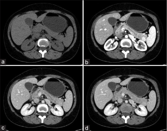 Intrapancreatic accessory spleen mimicking a pancreatic neuroendocrine tumour - An important but almost forgotten differential diagnosis.