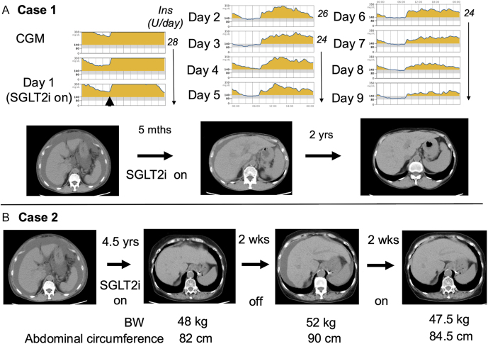 SGLT2 inhibitor administration to two patients with diabetes mellitus with ascites due to cirrhosis.