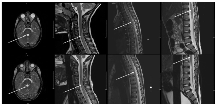 Beware of the Pediatric Limp: A Case of <i>Mycoplasma</i> Associated Acute Transverse Myelitis.