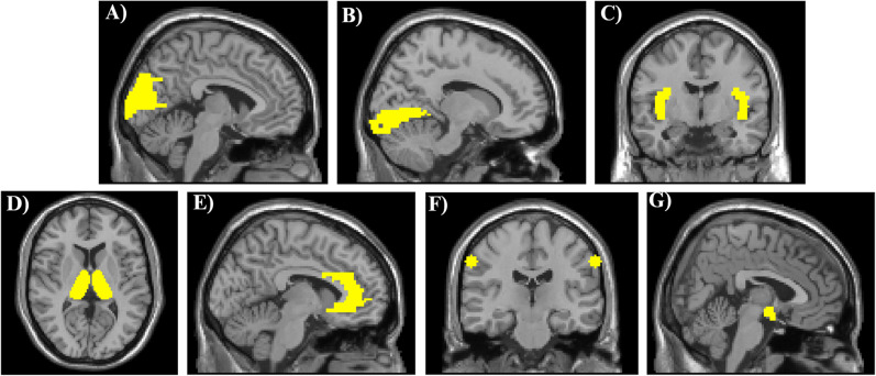 Shared neural signatures of photophobia in migraine and post-traumatic headache: a task-based fMRI study.