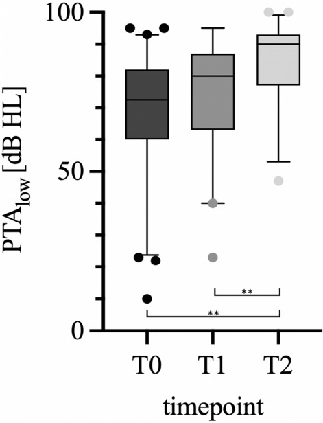 Cochlear implantation with Slim Modiolar Electrode carriers enables hearing preservation.