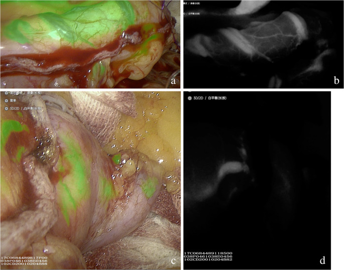 Application of indocyanine green fluorescence angiography in laparoscopic sleeve gastrectomy: preliminary results.