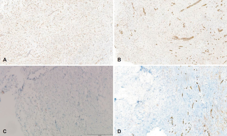Isolated Myxoma of the External Auditory Canal: A Rare Case Report.