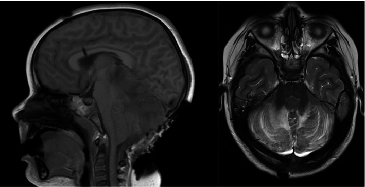 Accidental Methadone Toxicity in a 3-Year-Old Leading to Severe Cerebellitis and Death: A Case Report.