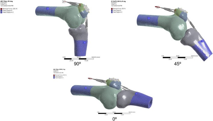 Finite Element Analysis of Patellofemoral Contact Pressure with Varying Fixation of Transverse Patella Fractures.