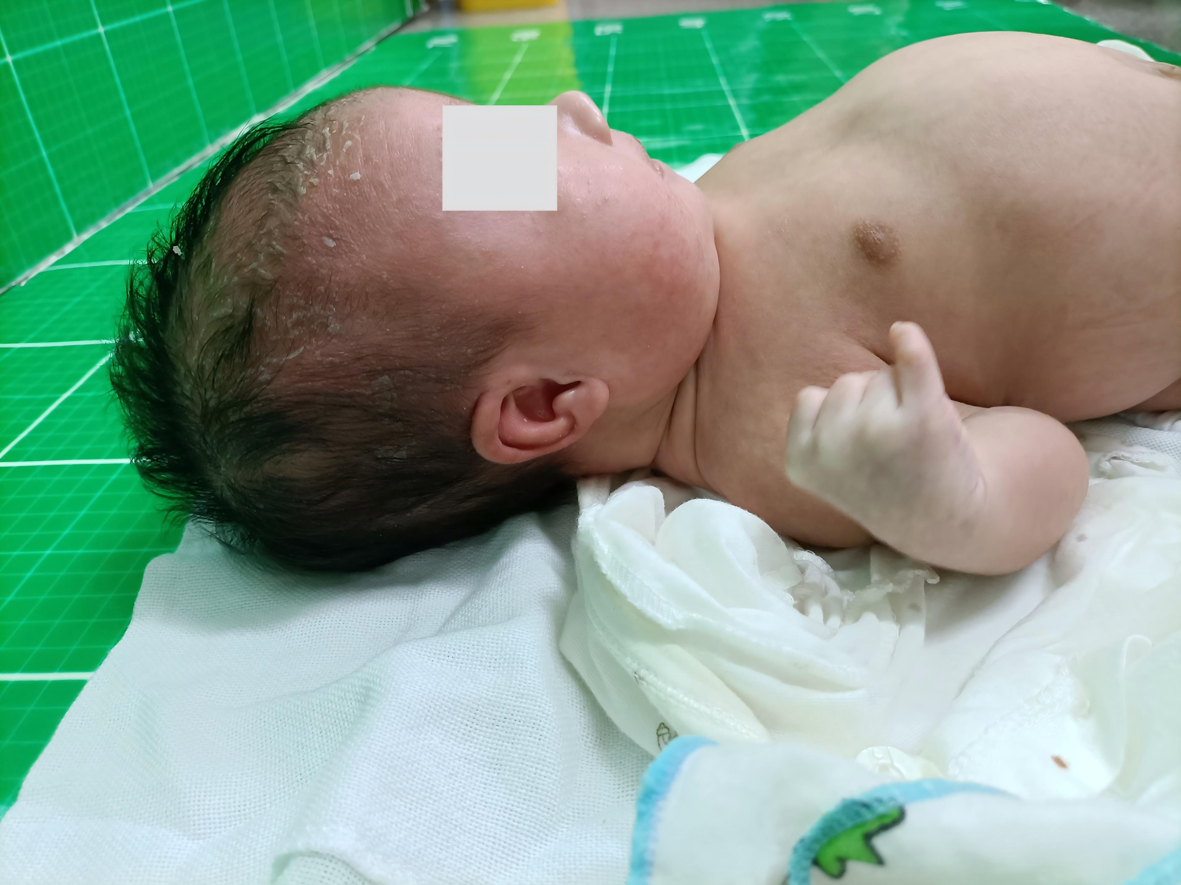 49, XXXYY: Parental Origin, Occurrence, and Clinical Phenotypes.
