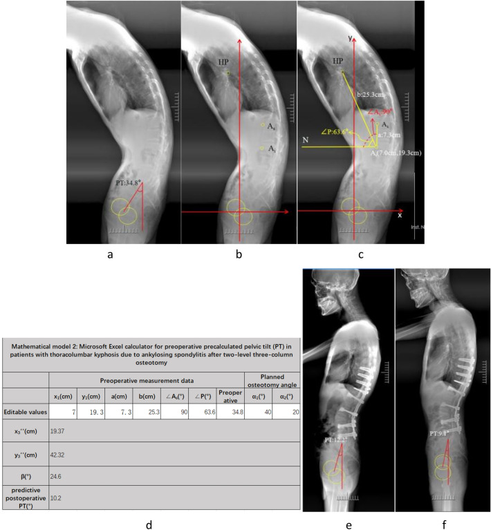 Novel mathematical model for preoperatively predicting pelvic tilt in patients with thoracolumbar kyphosis due to ankylosing spondylitis after three-column osteotomy.
