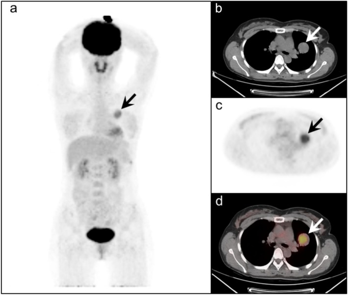 Characterization of Pulmonary Sclerosing Pneumocytoma Assessed by <sup>18</sup>F-FDG PET/CT.