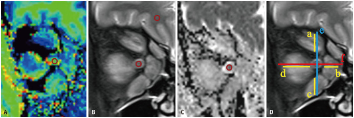 Multiparametric MRI for Diagnosing Dysthyroid Optic Neuropathy: Added Value of Magnetization Transfer Imaging.