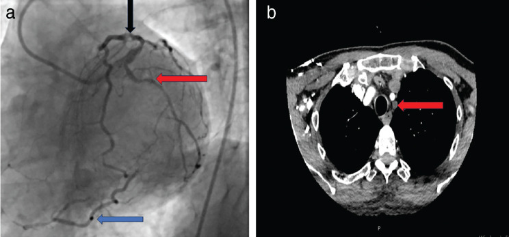 A Novel Approach for the Treatment of Subclavian Steal Syndrome in a Patient Undergoing Coronary Artery Bypass Grafting