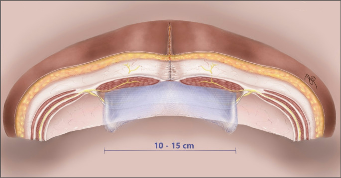 Abandoning mesh "overlap" in favor of "width" and its importance in open retromuscular midline incisional hernia repair: a nationwide database study.