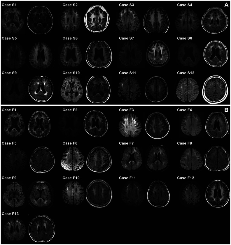 Diverse Clinical Phenotypes of Neuronal Intranuclear Inclusion Disease in South Korea.