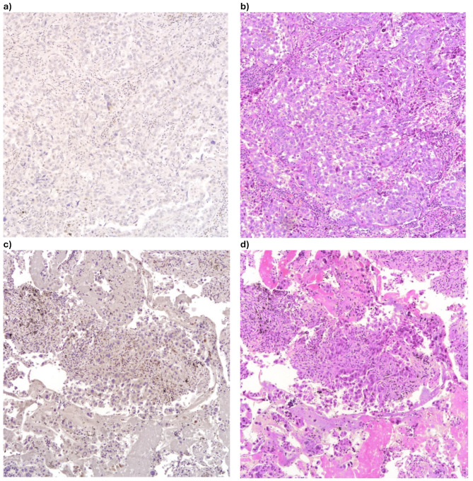 p53 aberrant expression is pervasive in pleomorphic carcinomas of the lung and a sensitive diagnostic adjunct for biopsy specimens.