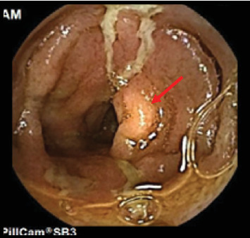 Familial Mediterranean Fever as a Cause of Recurrent Pleurisy in a Child With Crohn's Disease: A Case Report.