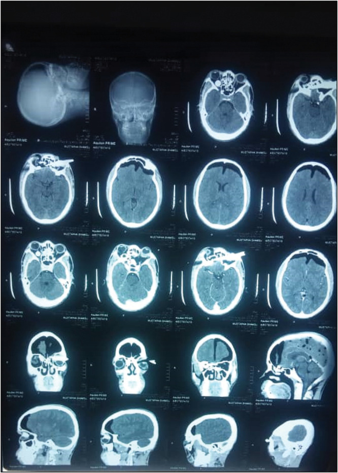 Intra-orbital Foreign Body.